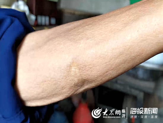 2宋汉启左胳膊的伤疤，为子弹击穿所致。军旅生涯，他曾四次负伤.jpg