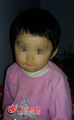 临沂2岁女童病危 父母欲捐献孩子眼角膜