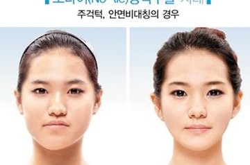 调查显示韩“锥子脸”整容过半术后出问题