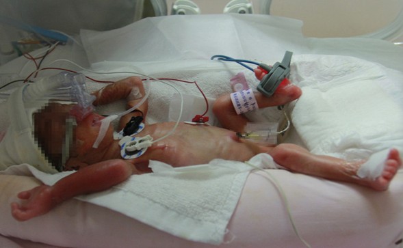 新生女婴尿道口有肉芽图片