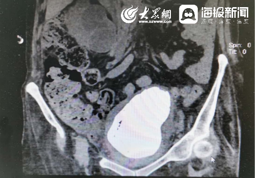 膀胱结石b超报告图片图片